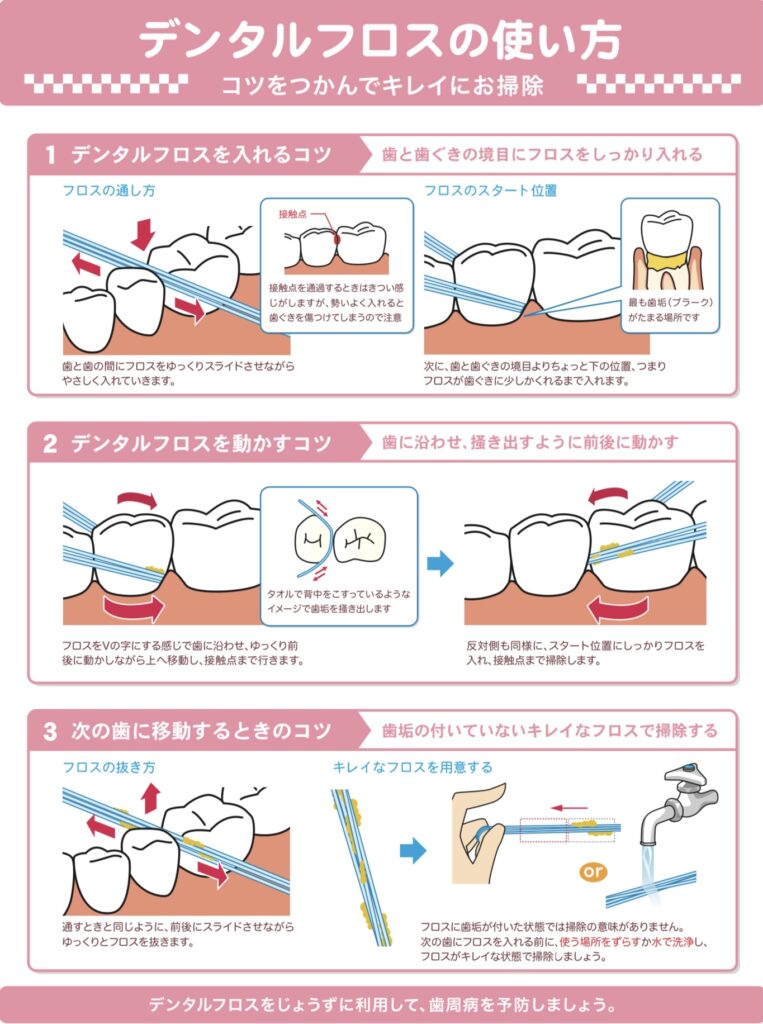 食べかすがつまりやすく、手入れがしにくいです - 治療実績集審美治療大阪の歯科クリニック MDENTAL STUDIO