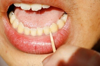 食べかす、歯垢、歯石の違い三宮アップル歯科